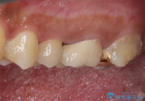 食事で痛む 神経を極力残した虫歯治療の治療前