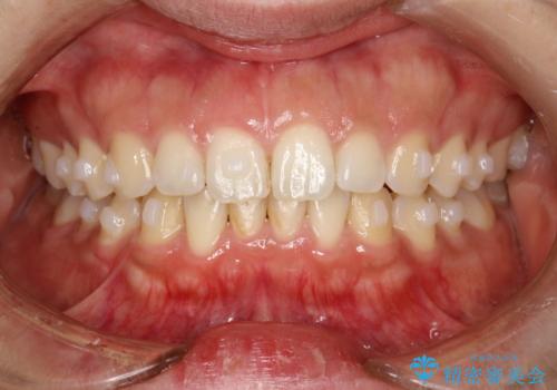 インビザライン中に歯の着色落としクリーニング PMTCの治療前