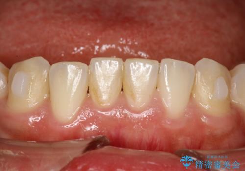 インビザライン中に歯の着色落としクリーニング　PMTCの症例 治療前