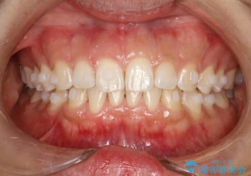 インビザライン中に歯の着色落としクリーニング PMTCの治療後