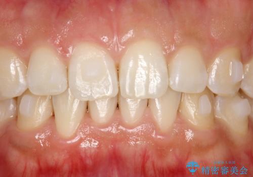 インビザライン中に歯の着色落としクリーニング PMTCの治療後