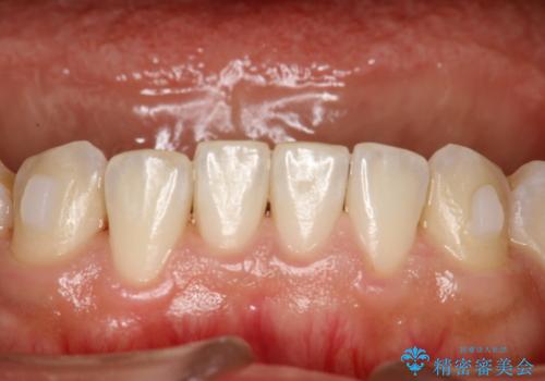 インビザライン中に歯の着色落としクリーニング　PMTCの症例 治療後
