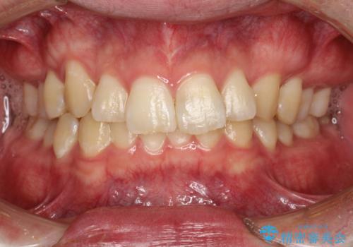 定期的なメンテナンスで歯磨きチェックの治療前