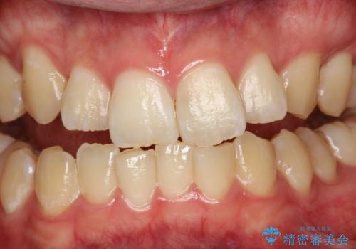 定期的なメンテナンスで歯磨きチェックの症例 治療前