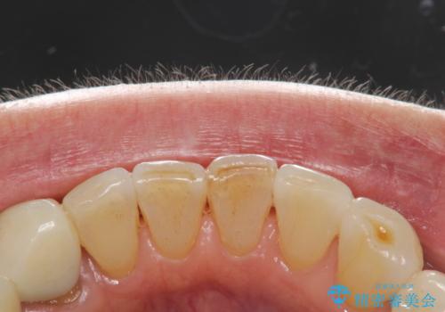 インビザライン中に歯の着色落としクリーニング PMTCの治療前