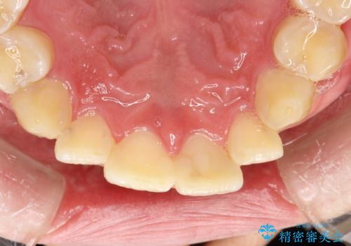 定期的なメンテナンスで歯磨きチェックの治療前