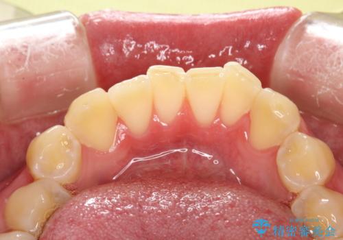 定期的なメンテナンスで歯磨きチェックの治療前