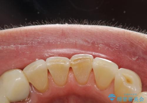 インビザライン中に歯の着色落としクリーニング PMTCの治療後