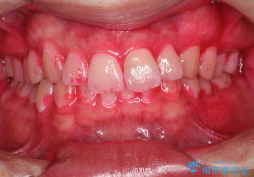 定期的なメンテナンスで歯磨きチェックの治療中