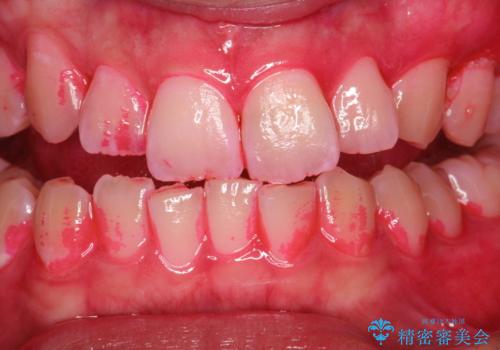 定期的なメンテナンスで歯磨きチェックの治療中