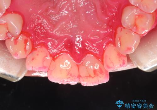 定期的なメンテナンスで歯磨きチェックの治療中