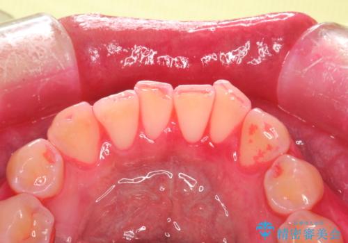 定期的なメンテナンスで歯磨きチェックの治療中