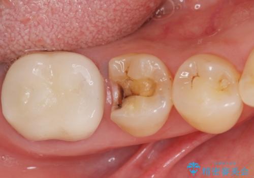 銀歯がしみる PGA(ゴールド)インレーへ 40代女性の治療中