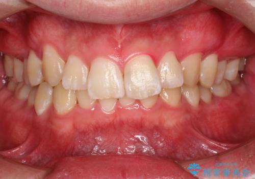 定期的なメンテナンスで歯磨きチェックの治療後