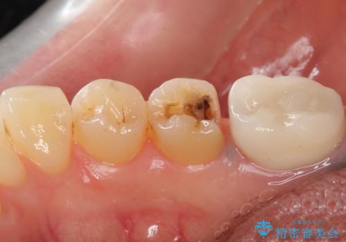銀歯がしみる PGA(ゴールド)インレーへ 40代女性の治療中