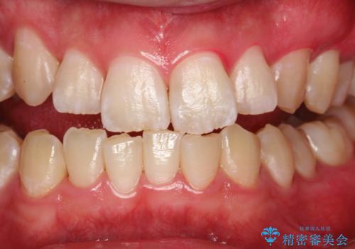 定期的なメンテナンスで歯磨きチェックの症例 治療後