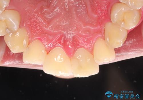 定期的なメンテナンスで歯磨きチェックの治療後