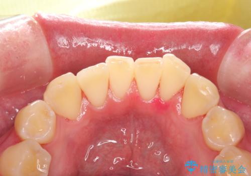 定期的なメンテナンスで歯磨きチェックの治療後