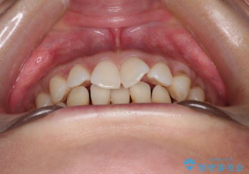 前歯のがたつきと隙間の矯正 インビザラインにての治療前