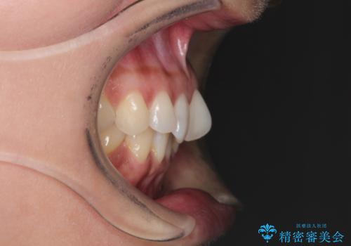 前歯のがたつきと隙間の矯正　インビザラインにての治療前