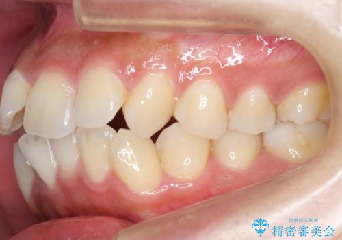 えっ シワが矯正で消えちゃう・・・? ボトックスから卒業しようの治療前