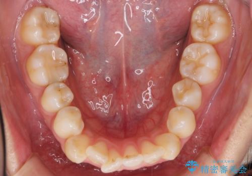 えっ シワが矯正で消えちゃう・・・? ボトックスから卒業しようの治療前