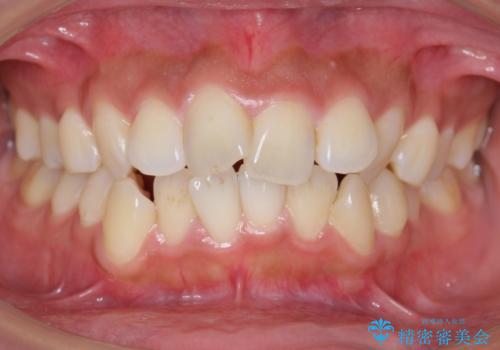 えっ シワが矯正で消えちゃう・・・? ボトックスから卒業しようの治療前