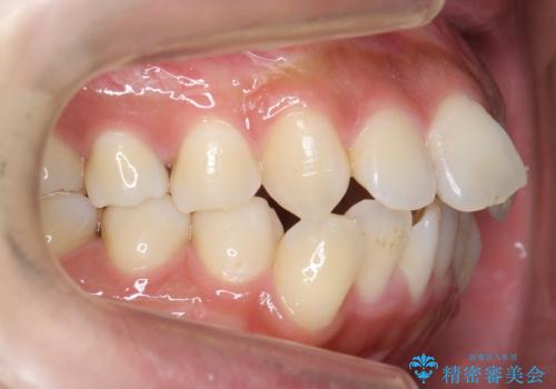 えっ シワが矯正で消えちゃう・・・? ボトックスから卒業しようの治療前