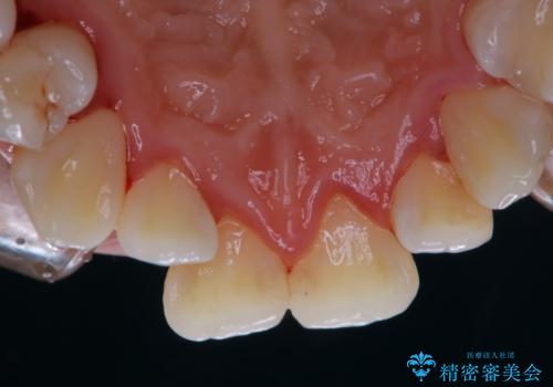 歯科矯正前のクリーニング PMTCの症例 治療後