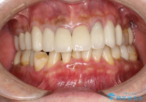 PMTCで歯石やステインOFFの治療前