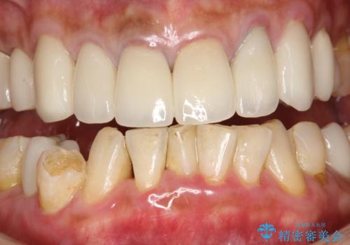 PMTCで歯石やステインOFFの治療前