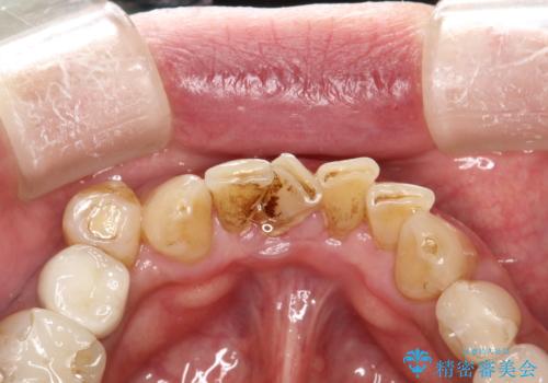 PMTCで歯石やステインOFFの症例 治療前