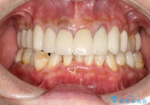 PMTCで歯石やステインOFFの治療後