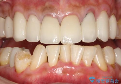 PMTCで歯石やステインOFFの治療後