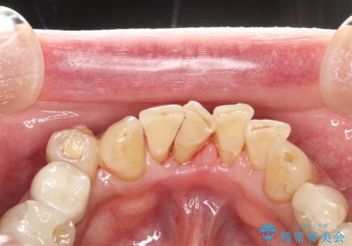 PMTCで歯石やステインOFFの症例 治療後