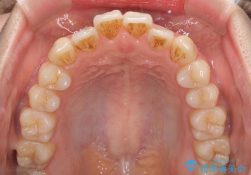 オープンバイトでかみにくい　インビザラインによる矯正治療の治療前