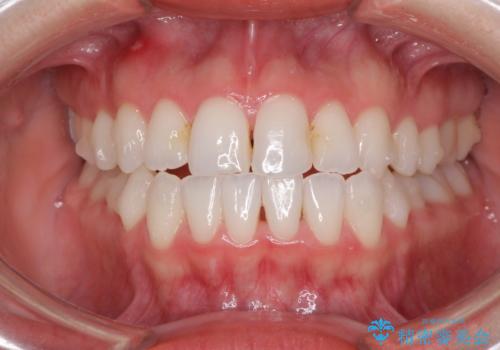前歯のクロスバイトを治したい インビザラインによる矯正治療の治療中