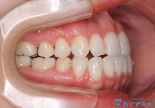 前歯のクロスバイトを治したい インビザラインによる矯正治療の治療中