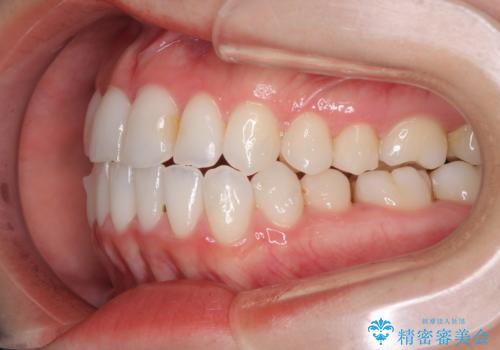 前歯のクロスバイトを治したい インビザラインによる矯正治療の治療中