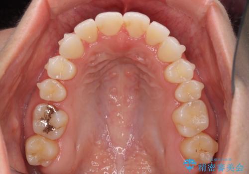 前歯のクロスバイトを治したい インビザラインによる矯正治療の治療中