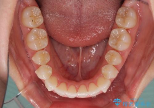 前歯のクロスバイトを治したい インビザラインによる矯正治療の治療中