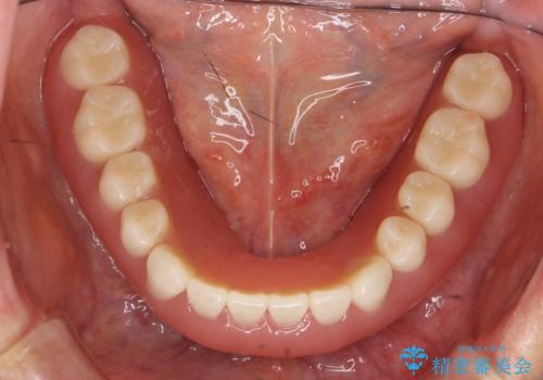 インプラントオーバーデンチャー 咬合平面の改善の治療後