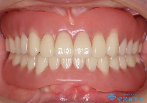 インプラントオーバーデンチャー 咬合平面の改善の治療後