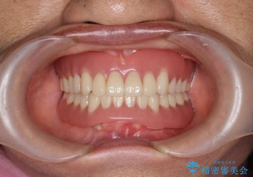 インプラントオーバーデンチャー 咬合平面の改善の治療後