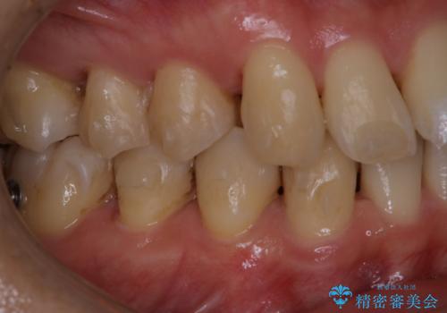 マウスピース矯正・インビザライン中のPMTCの治療前