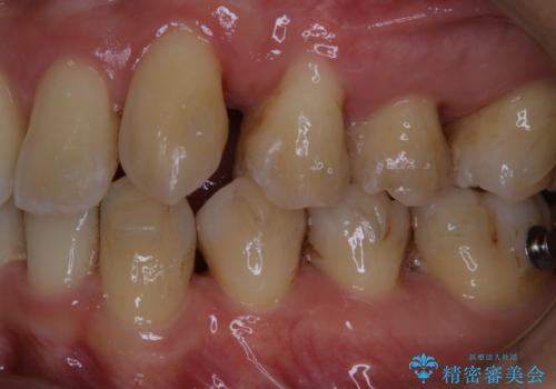 マウスピース矯正・インビザライン中のPMTCの治療前