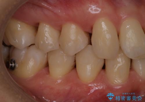 マウスピース矯正・インビザライン中のPMTCの治療後
