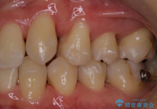 マウスピース矯正・インビザライン中のPMTCの治療後