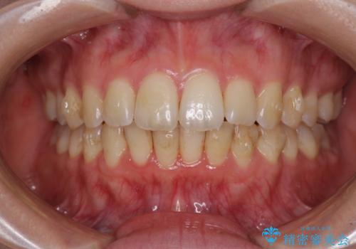 前歯のデコボコを解消 インビザラインによる矯正治療の治療中