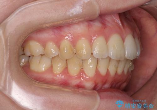 前歯のデコボコを解消　インビザラインによる矯正治療の治療中
